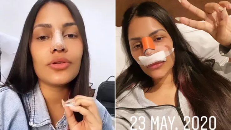 Flayslane fura isolamento para fazer cirurgia plástica no nariz   Celebridades   iG